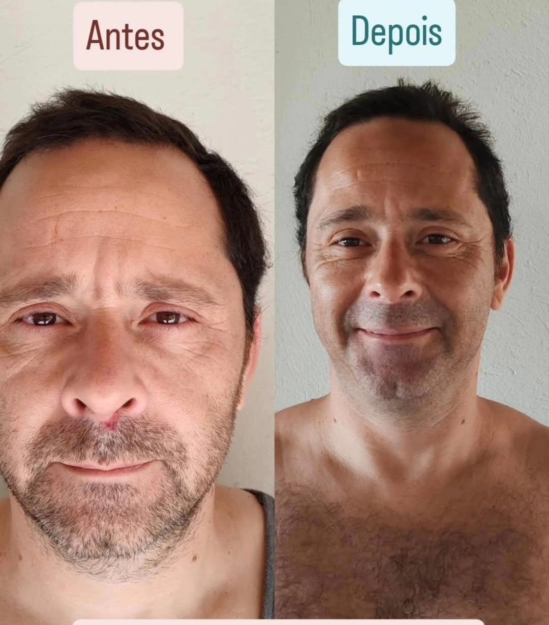 Antes e depois — Tomás T.
